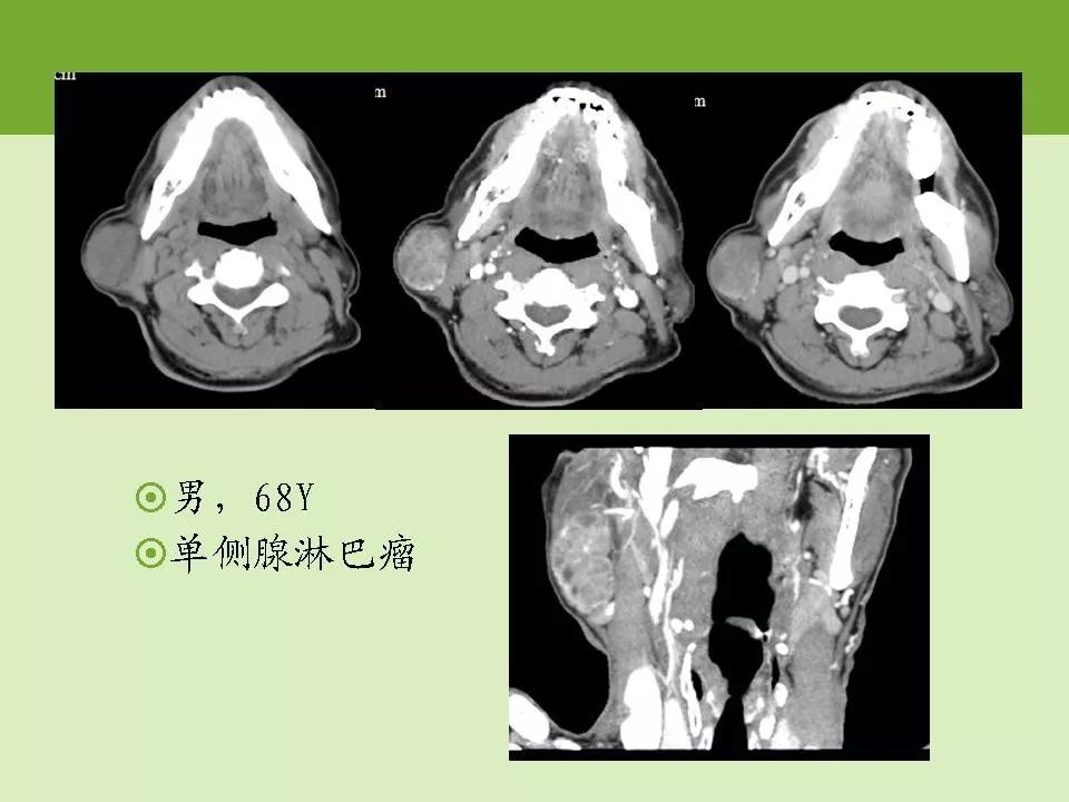 腮腺区常见病变的ct鉴别诊断影像天地