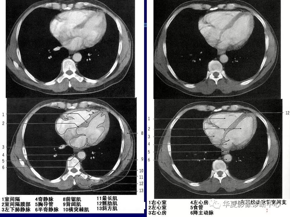 胸部ct解剖