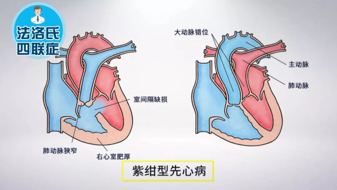 当胎儿出生后,可以自主呼吸了,动脉导管应该在一定时间内自动关闭.