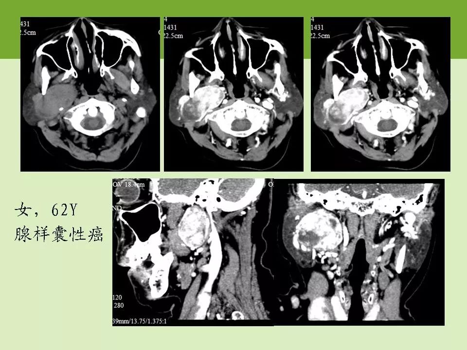 腮腺区常见病变的ct鉴别诊断 | 影像天地