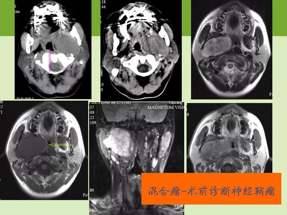 腮腺区常见病变的ct鉴别诊断影像天地