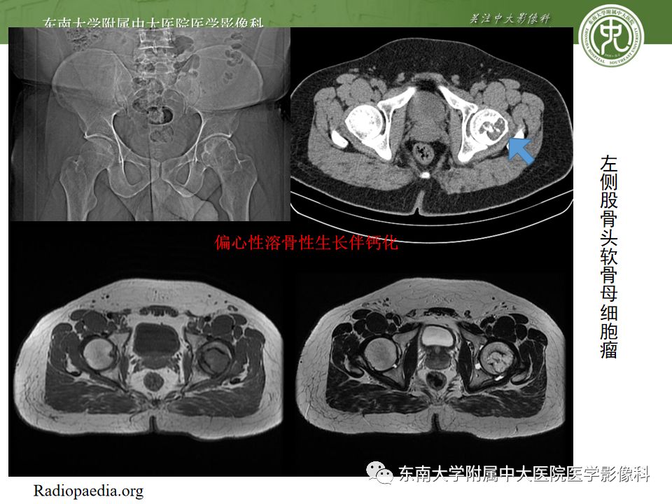 ct mr 编辑/校对:郑孝飞 病例结果: 左侧 股骨头缺血性坏死伴股骨颈