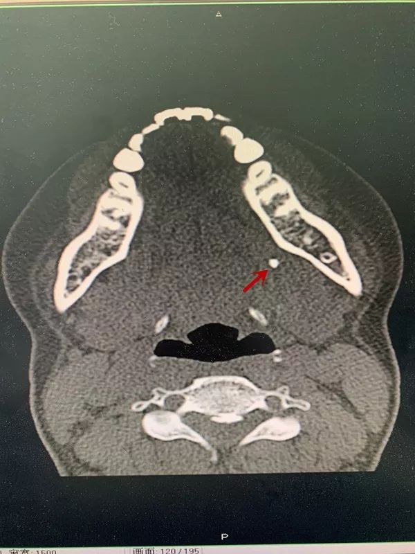 左颌下腺导管结石导管结石ct影像治疗1,保守治疗很小的唾液腺结石或者