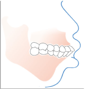 牙性龅牙,骨性龅牙,你的龅牙该怎样矫正?