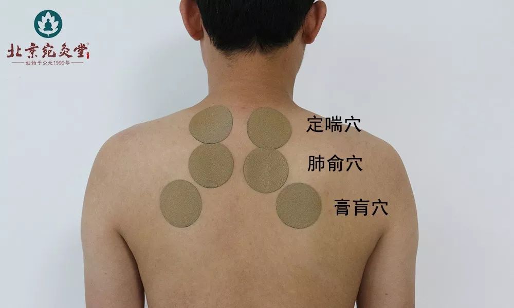 建议贴敷穴位：定喘、肺俞、膏肓、膈俞、天突、膻中……