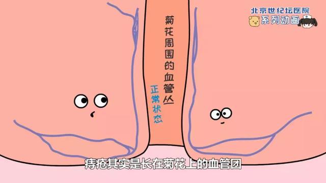 动画科普菊花的故事一原来你是这样的痔疮