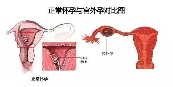 原創
            懷孕33天，稍微腹痛出血是不是宮外孕，宮外孕有什麼跡象？ 親子 第3張