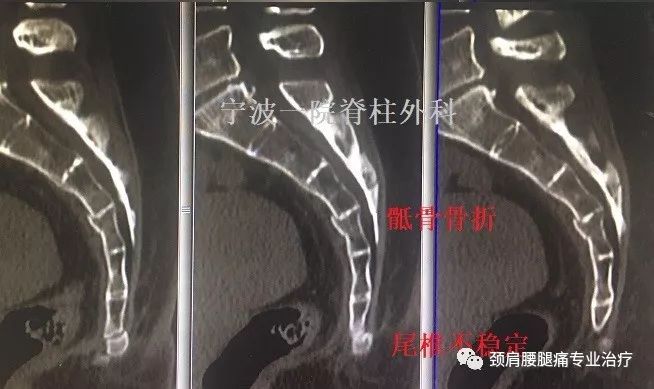 有一种尾骨痛,切不可掉以轻心