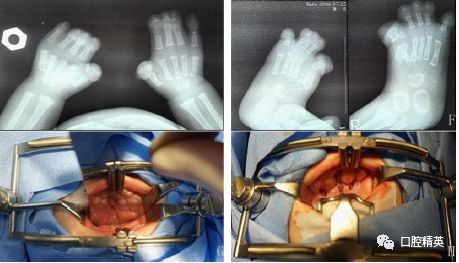 apert综合征腭裂整复术1例及相关文献复习