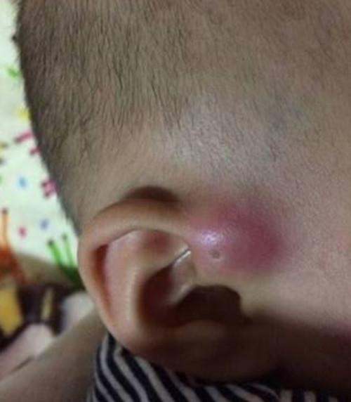                     原创            孩子耳边有个小孔，妈妈挤了下却因发炎要手术，这个孔你别乱碰