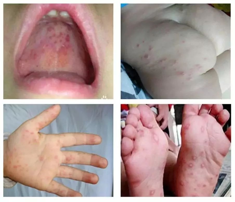 手足口病患儿和隐性感染者为主要传染源,手足口病隐性感染率高.