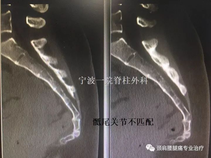 有一种尾骨痛,切不可掉以轻心