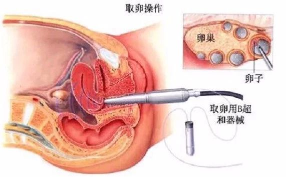 人有多少颗卵子 99346b7d91cd44e296dae8a01dab4986.jpeg