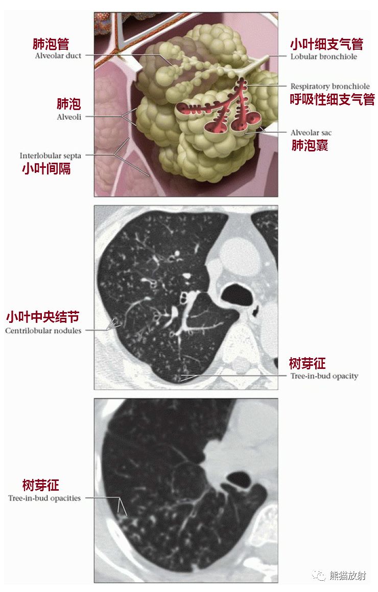 小叶细支气管分支为远端的小气道,包括呼吸性细支气管,肺泡管,肺泡囊