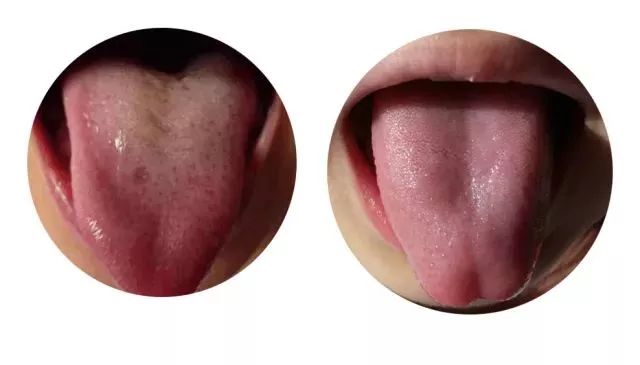 如何通过舌头可以了解疾病?
