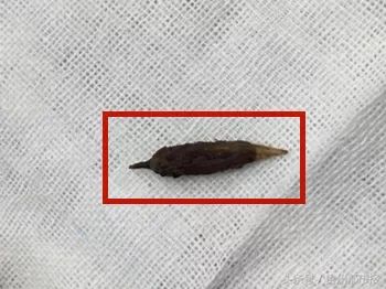                     4天前的一口粥，男孩肠子被刺穿！大人小孩都要注意！