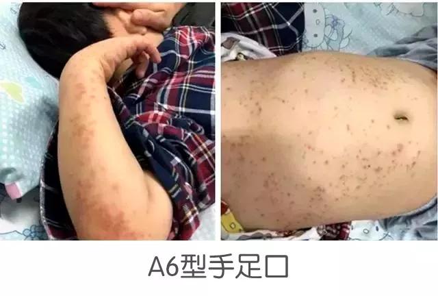                     “新型手足口”爆发？全身长疹、指甲脱落，5岁以下是重灾区
