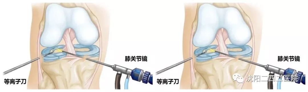 神奇的关节镜技术…_手术