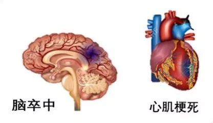 动脉硬化检测的原理是什么_动脉硬化检测(2)