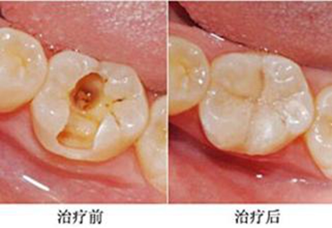 牙齿磨口腔内壁怎么办