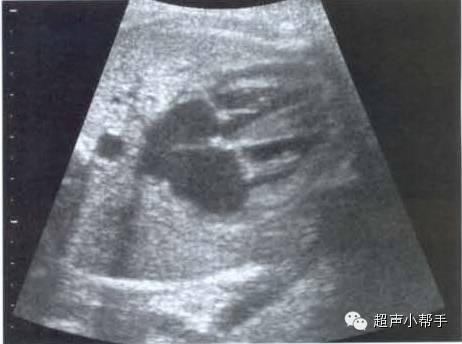 手把手教你做胎儿超声心动图