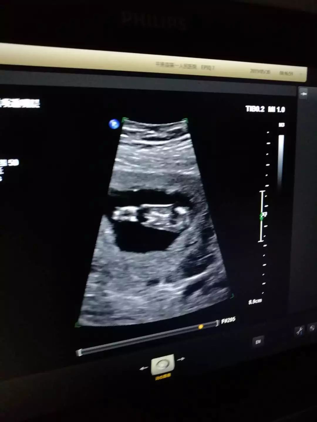 5月30日上午,我院彩超室医生为一早孕13周孕妇做超声检查时,彩超检查