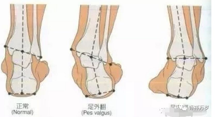踝关节正确关节位置距腓前韧带和跟腓韧带是踝内翻损伤常见的损伤韧带