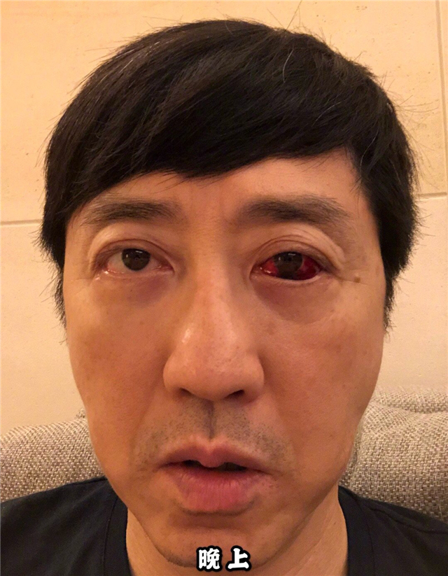 庾澄庆眼睛受伤太恐怖,发文调侃"火眼金睛",不服老工作太拼