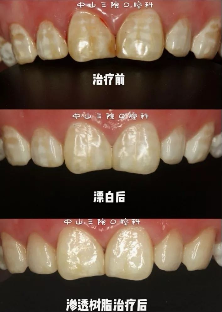 做好了这几条,爸妈们就不必暑假赶场带娃看牙了!