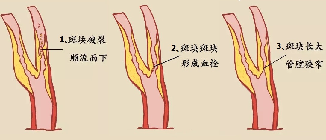 颈动脉一旦被堵,脑梗就会随之而来,原因大致有以下3点: 1,斑块破裂