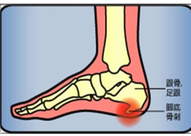 女子脚后跟长骨刺脚一挨地疼到骨头里足跟痛5个办法可缓解