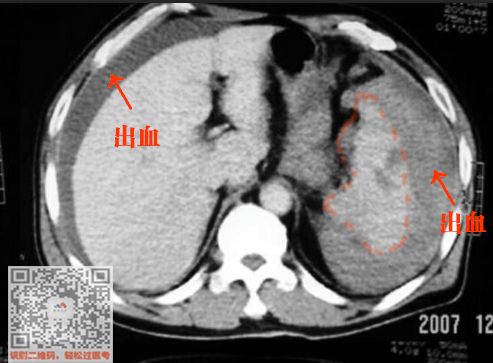 不要将上图肝周的积血看成肝脏破裂是脾脏破裂后,血流到那里去的这个