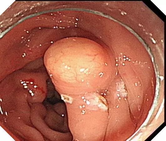 病例  :直肠 神经内分泌肿瘤经 内镜切除