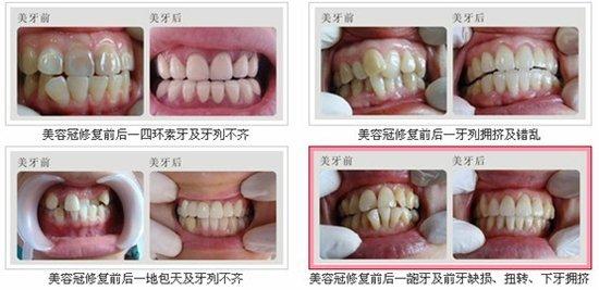 牙齿磨口腔内壁怎么办