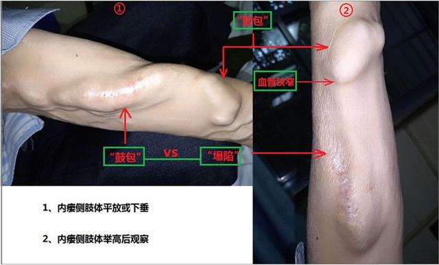 如何做好自体动静脉内瘘安全管理?一文告诉你