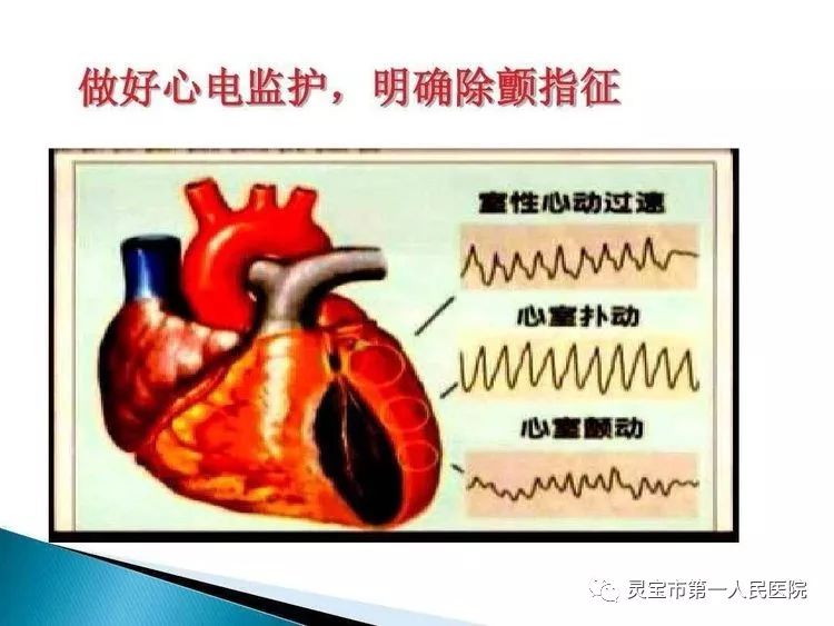 医学界普遍认为电除颤是治疗室颤的最有效方法,愈早实施成功率愈高