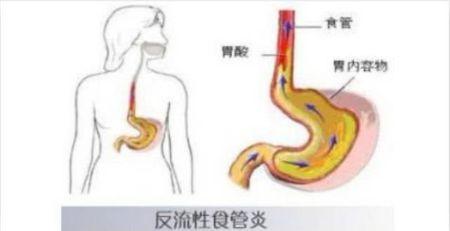 身体出现这四种异常可能是反流性食管炎在作怪