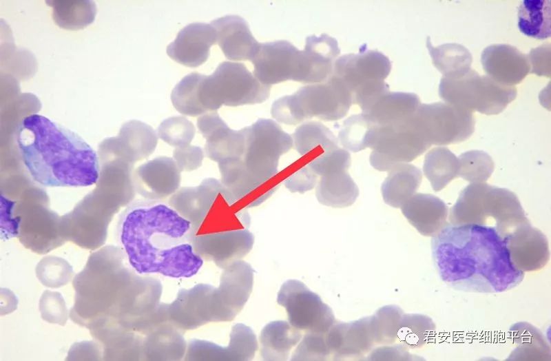 细胞骨髓涂片颗粒增多中性杆状核粒细胞大红细胞外周血涂片腹部彩超示