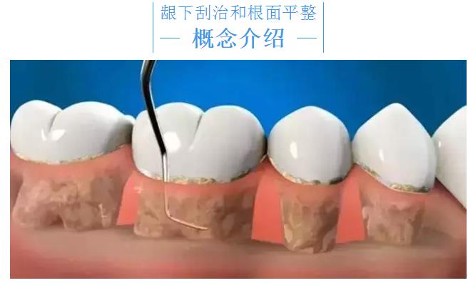 龈下刮治,根面平整技术,医生必收藏