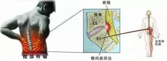 臀部连着腿疼怎么办