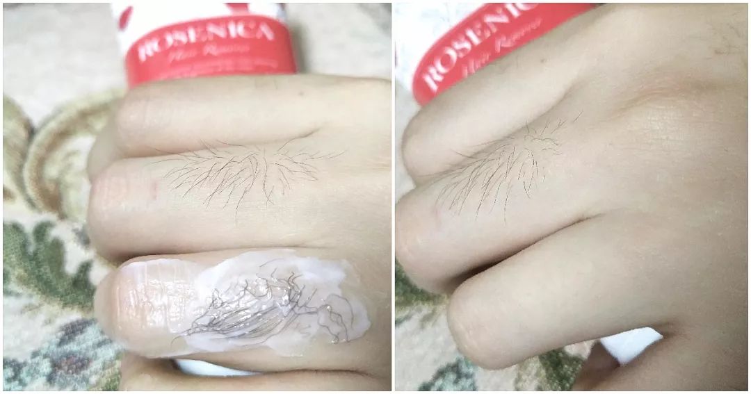 脱毛美白一步到位,今夏不做猕猴桃女孩!