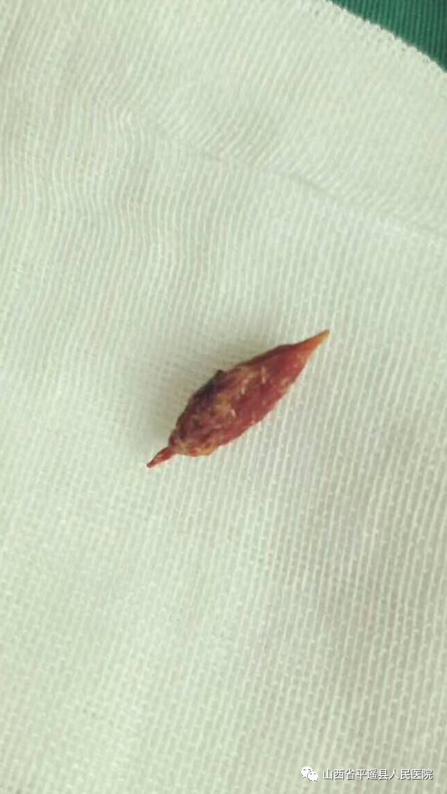 端午节温馨提示谨慎枣核卡喉咙4例枣核卡食管看医生硬核巧取出