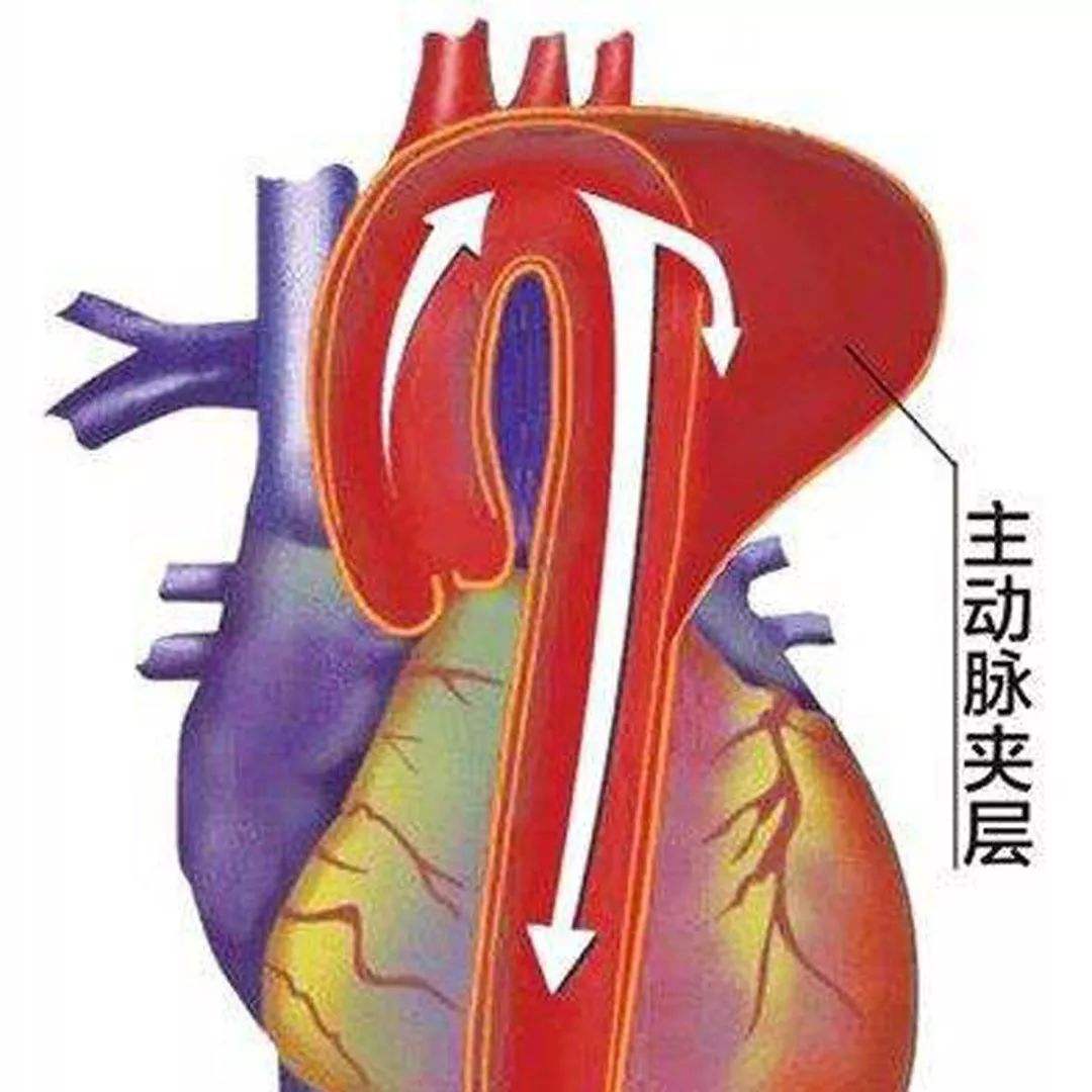 主动脉夹层如同人体的"定时炸弹",看常德市第二人民医院大夫如何成功