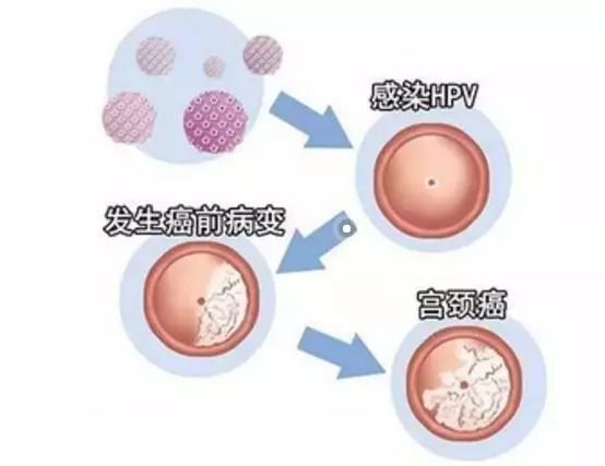 7%的宫颈癌患者存在高危型hpv感染.