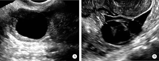 5-1-8 卵泡内部回声超声示意图