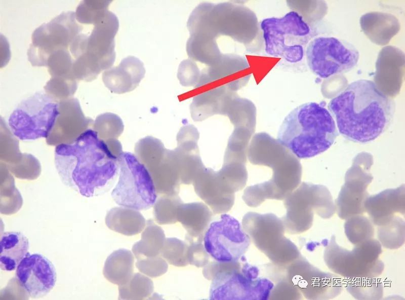 不同寻常的大细胞性贫血探因之路
