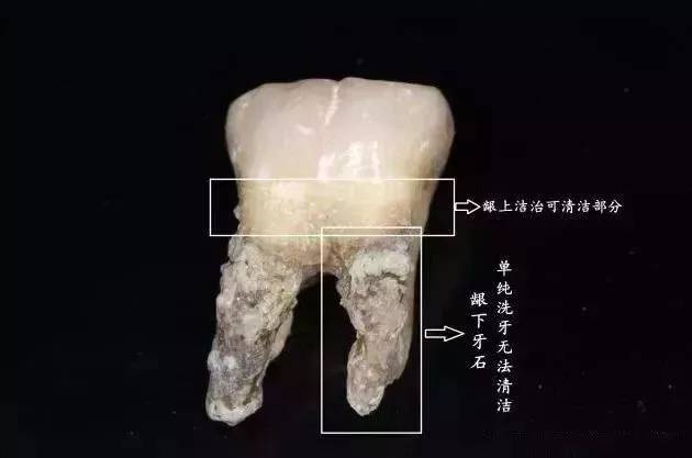 高伟丽详解你看不见的隐形的牙齿杀手龈下结石