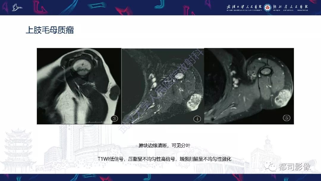 罕见病 | 毛母质瘤影像诊断