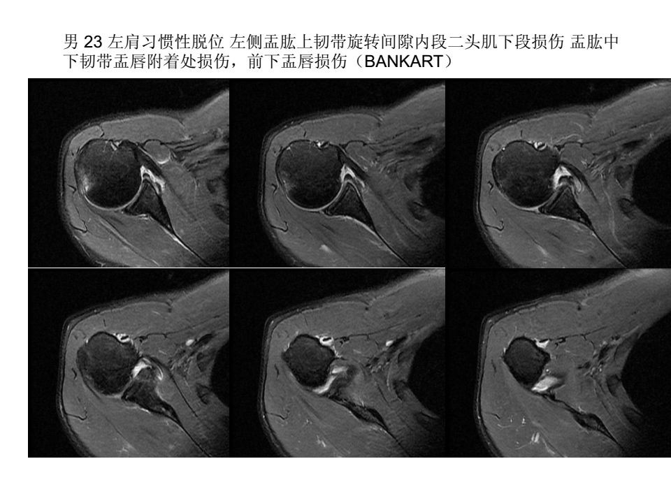 肩关节韧带解剖及损伤影像表现