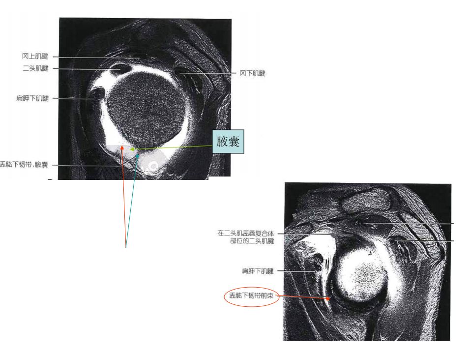 肩关节韧带解剖及损伤影像表现